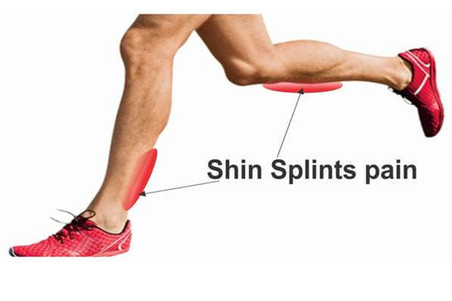 Painful-Shins-Shin-splints