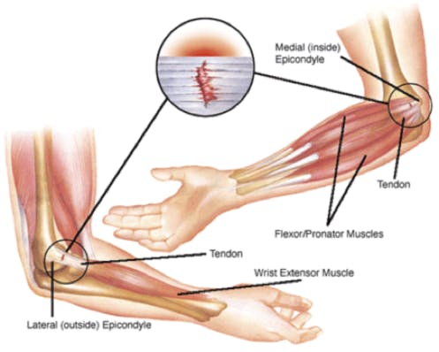 Elbow Exercises